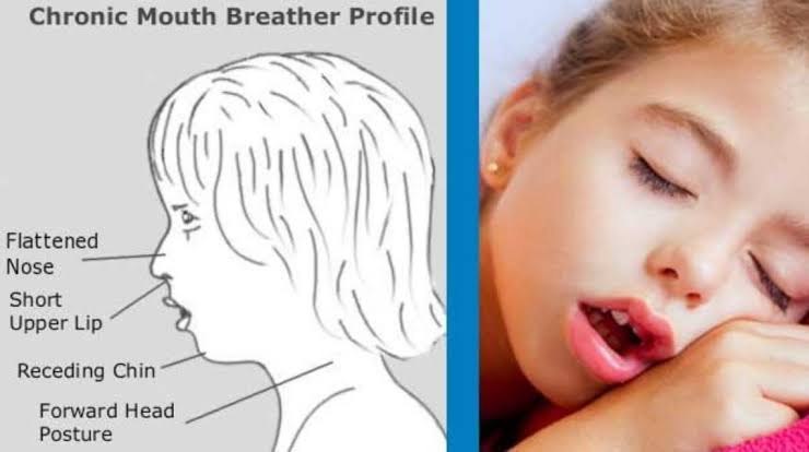 Mouth breathing and its impact - SmileXpressions Multispeciality Dental ...