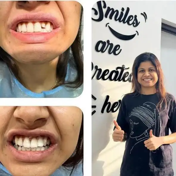 Cosmetic Dentistry in Bangalore