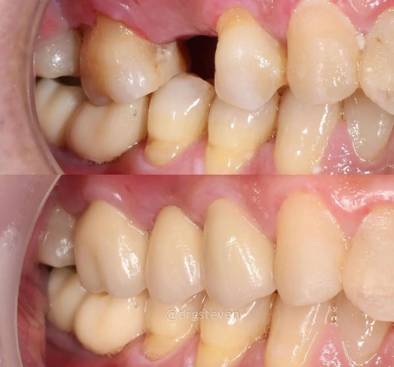 Dental Bridges and Crowns in banglore