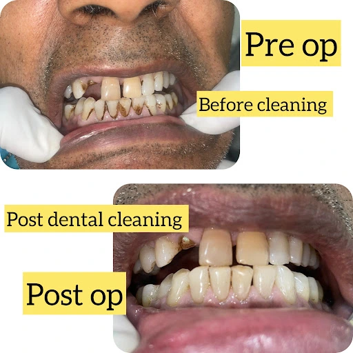 Gum disease treatment in banglore