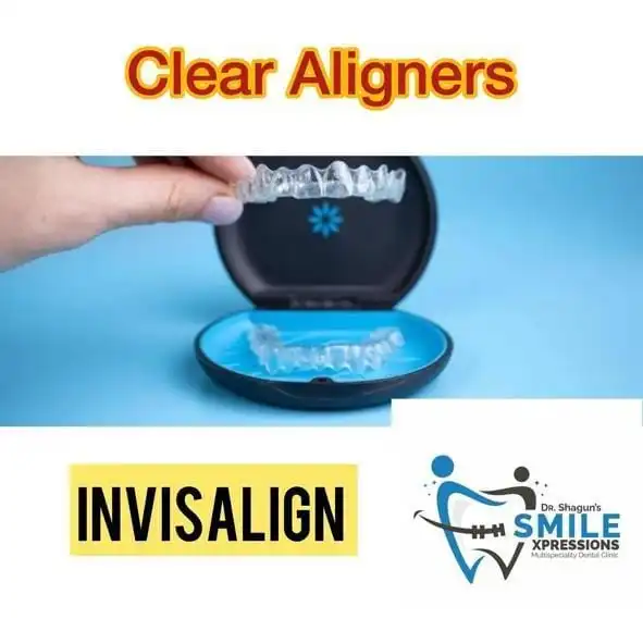Invisalign Braces in banglore