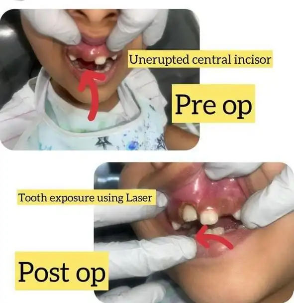 Laser Dentistry in Bangalore