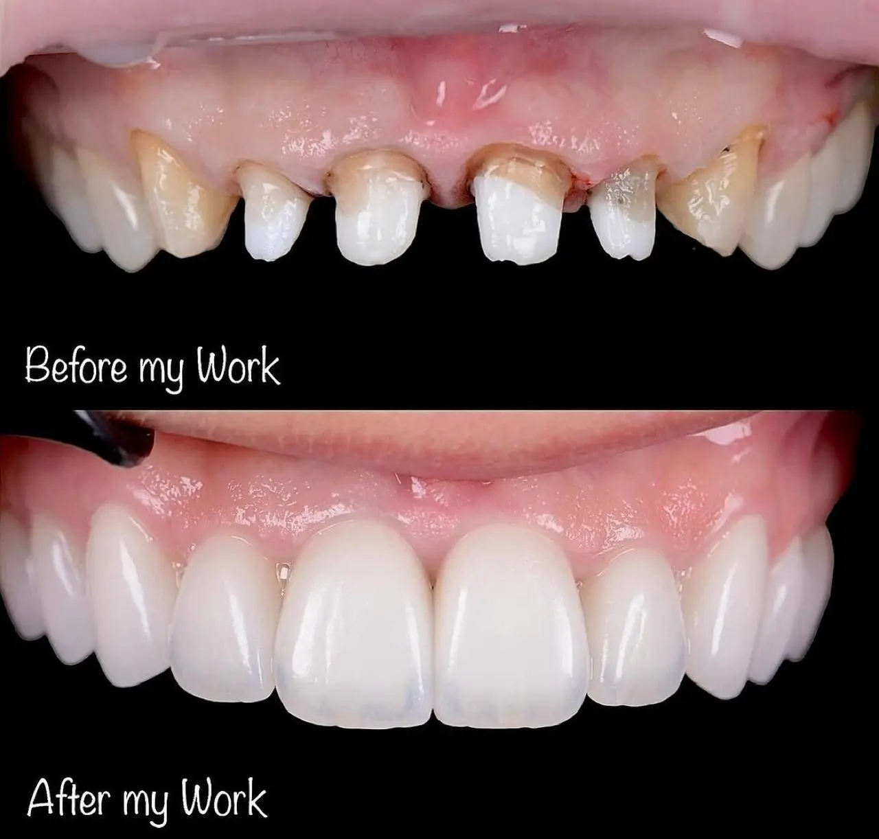 Lumineers Veneers in banglore