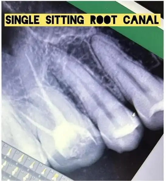 Root Canal Treatment in banglore